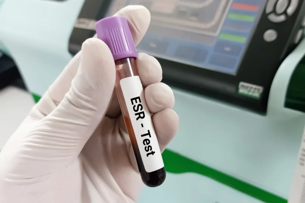 تعرف على فحص ترسيب الدم ESR، كيفية قراءته وفهم نتائجه، والأسباب المحتملة لارتفاع سرعة الترسيب. اكتشف المعدلات الطبيعية للبالغين، الفرق بين ESR و CRP، وطرق إدارة مستويات ESR المرتفعة. احصل على معلومات حول تكلفة الفحص في الأردن وكيفية التحضير له.