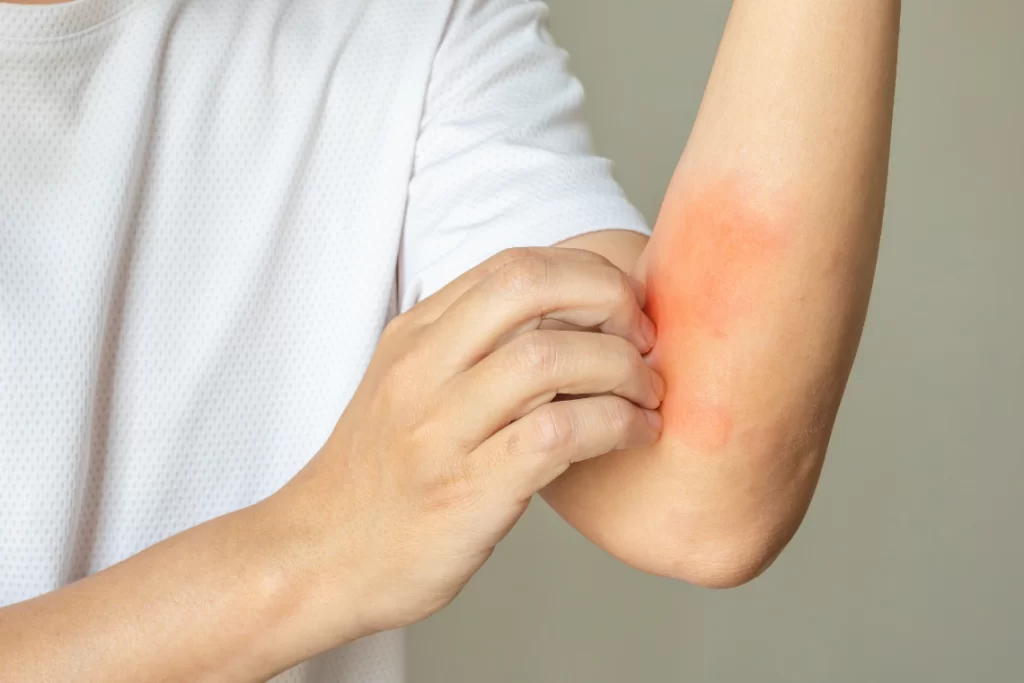 Psoriasis causes red, scaly patches on the skin due to rapid cell turnover